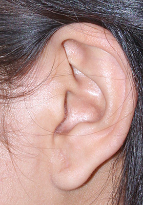 Photo of Ear After Earlobe Surgery