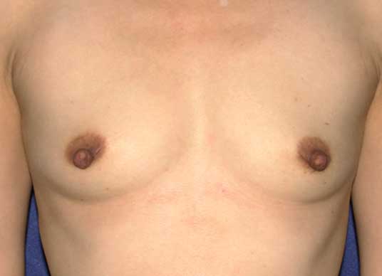photo of breasts before breast augmentation