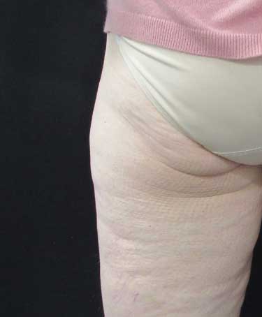 Before Photo of CoolSculpting on Outer Thigh