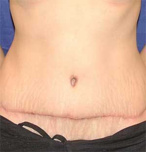 photo of torso following tummy tuck procedure