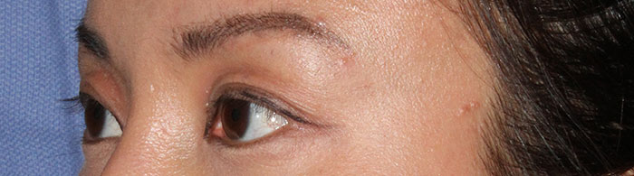 photo of eyes before asian eyelid surgery