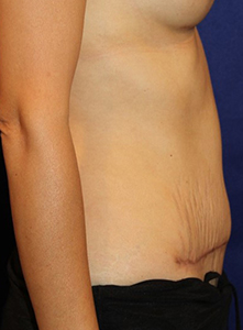 Sideview of tummy tuck  after procedure